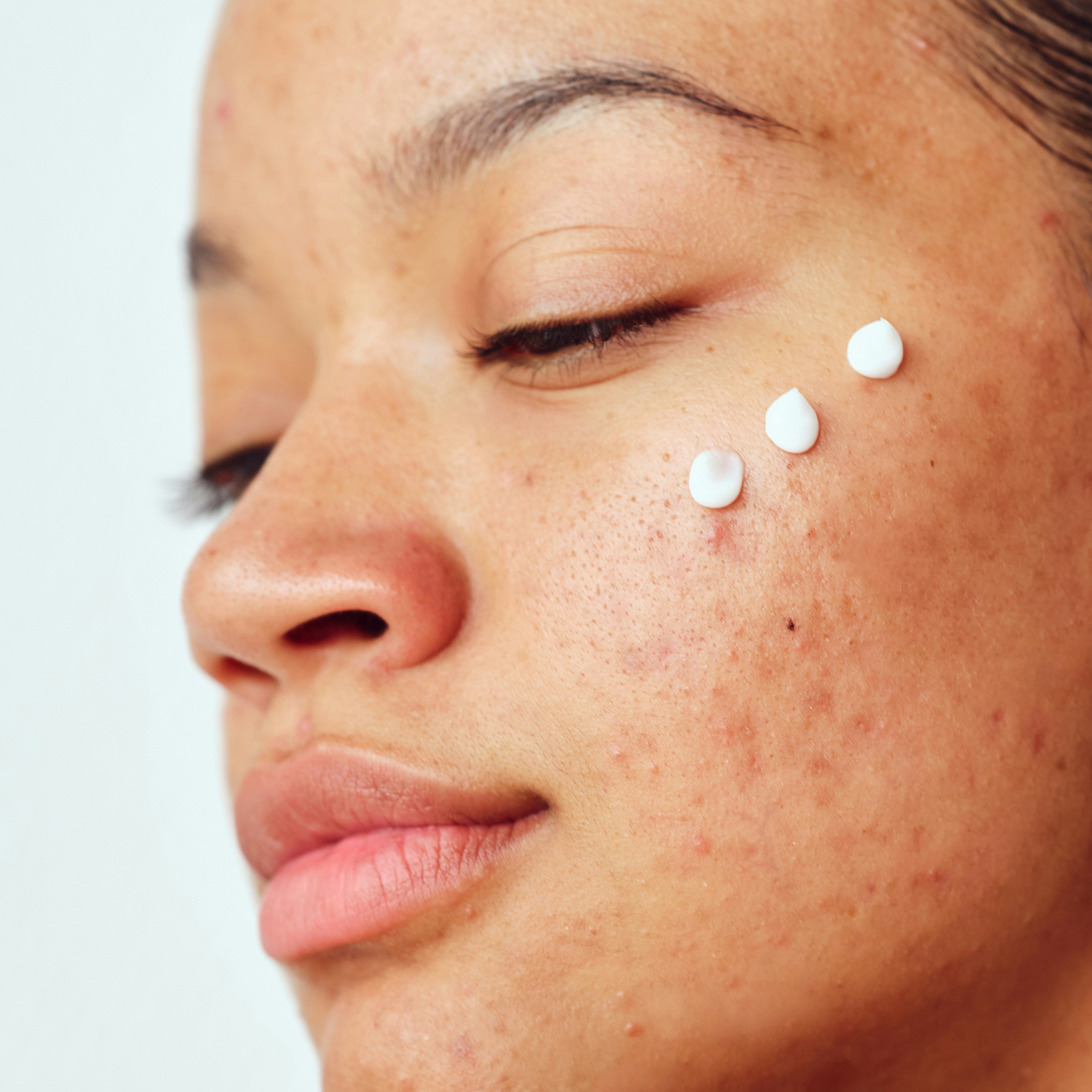 Exploring the Benefits of Niacinamide for Acne-Prone Skin